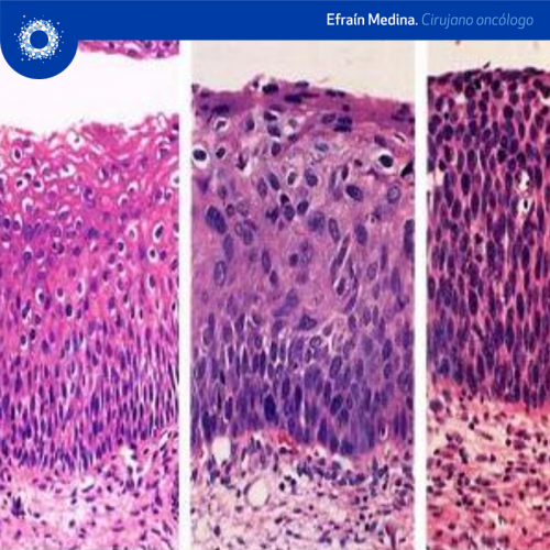 video neoplasia intraepitelial cervical nic cancer y oncología medina